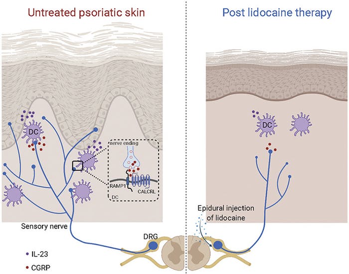 Epidural Nerve Block with Lidocaine Leads to Clearance of Psoriatic
